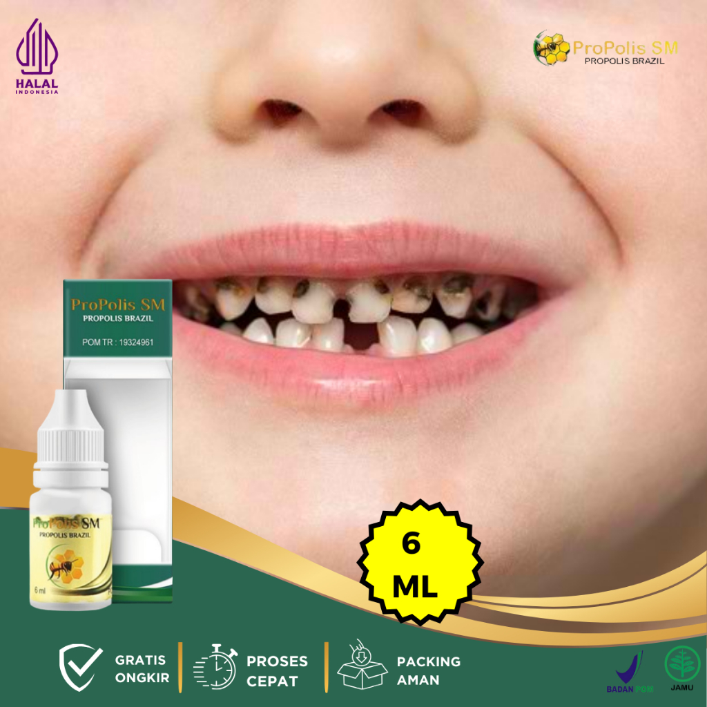 Obat Gigi Rusak, Obat Gigi Rusak Pada Anak, Obat Gigi Hitam, Obat Gigi Berlubang Hitam, Obat Gigi Ke