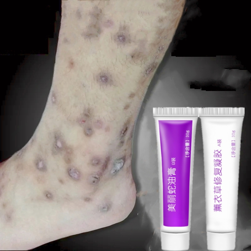 Salep penghilang bekas luka Penghilang bekas luka hitam koreng Penghilang Bekas luka bakar knalpot