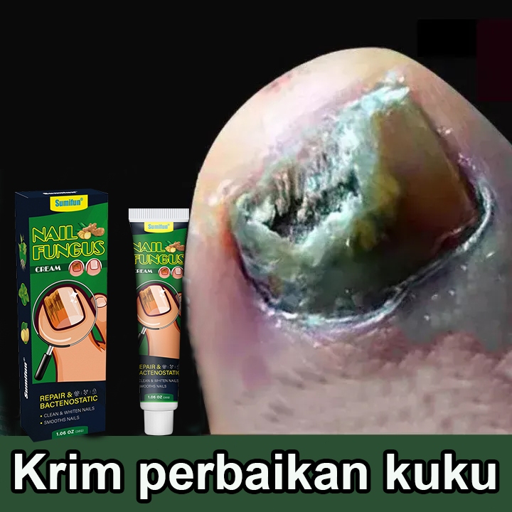 obat kuku obat jamur kuku 30g obat kuku jamur dan rusak obat jamur kuku kaki obat kuku rusak Perawat