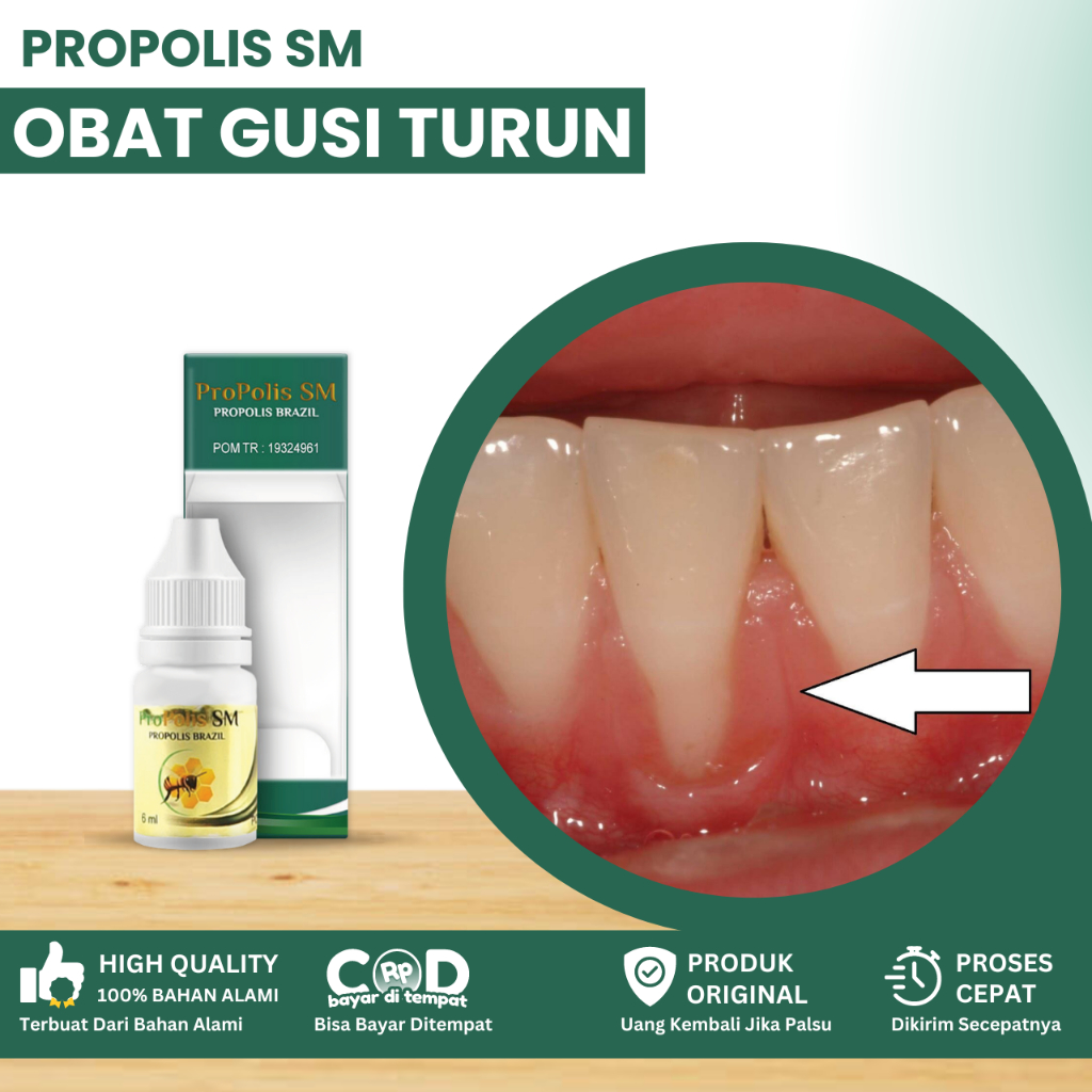 Obat Gusi Turun, Obat Gusi Bengkak Sakit, Obat Kumur Untuk Gusi Turun Kebawah, Obat Resesi Gusi, Oba