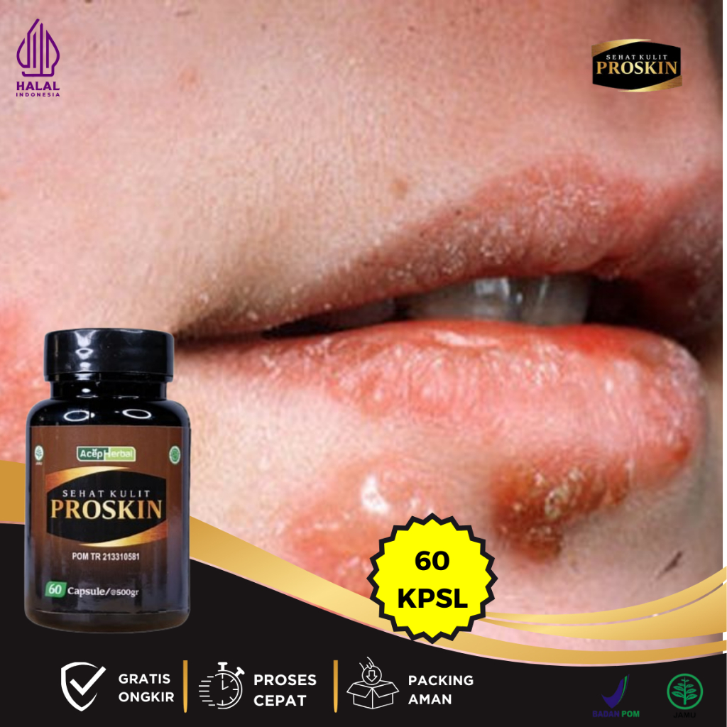 Obat Herpes Kulit, Obat Herpes Bibir, Obat Herpes Kelamin, Obat Herpes Genital, Obat Herpes Zoster, 