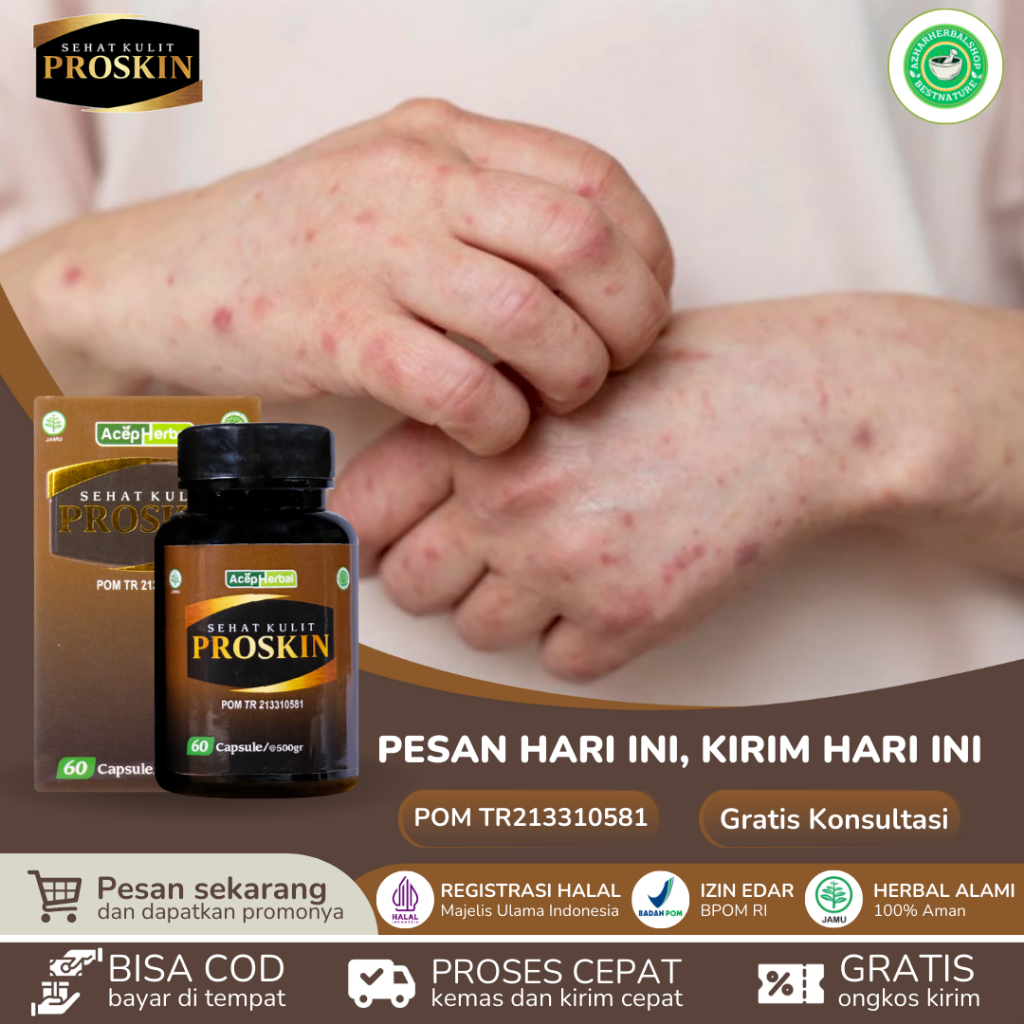 PROSKIN Obat Budug Seluruh Badan Gatal Penghilang Korengan Scabies Manusia Skabies Babak Gudik Budug