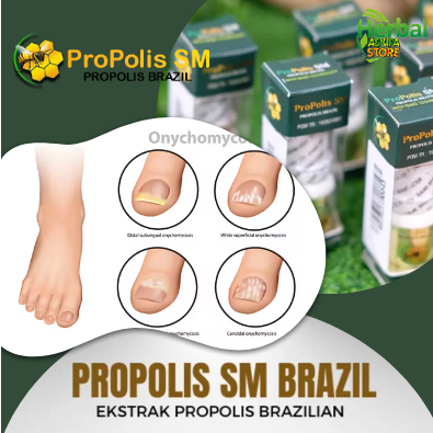 Obat Jamur Kuku Alami, Obat Alami Jamur Kuku, Obat Alami Untuk Jamur Kuku, Jamur Kuku Kaki Obat alam