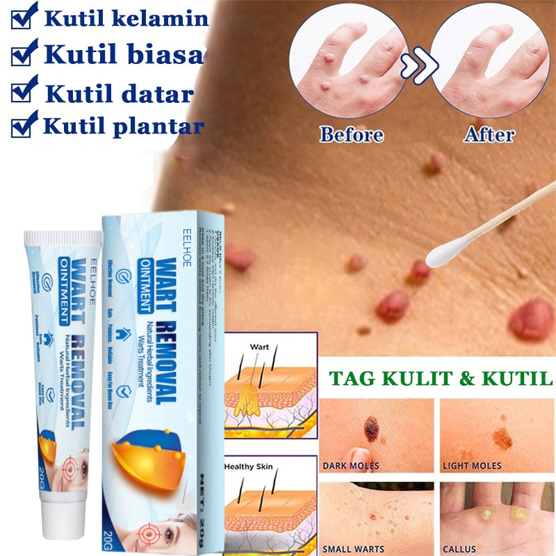 PROMO Penghilang Kutil Dan Tahi Lalat Penghilang Kutil Di Wajah Penghilang tahi lalat di wajah Skin