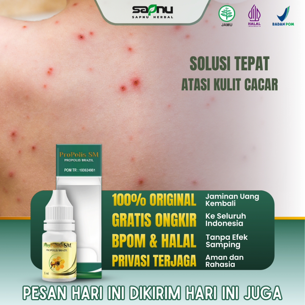 ProPolis SM - Obat Cacar Air, Salep Cacar Air, Obat Penghilang Luka Bekas Cacar, Obat Cacar Api, Oba