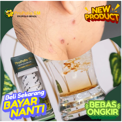 salep penghilang bekas cacar yang berlubang, penghilang bekas cacar yang sudah lama, penghilang beka