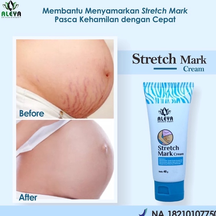 KODE Q37T Cream Penghilang Stretch Mark Aleya Kerutan di Badan Perut Tangan Lengan Paha Payudara Bok
