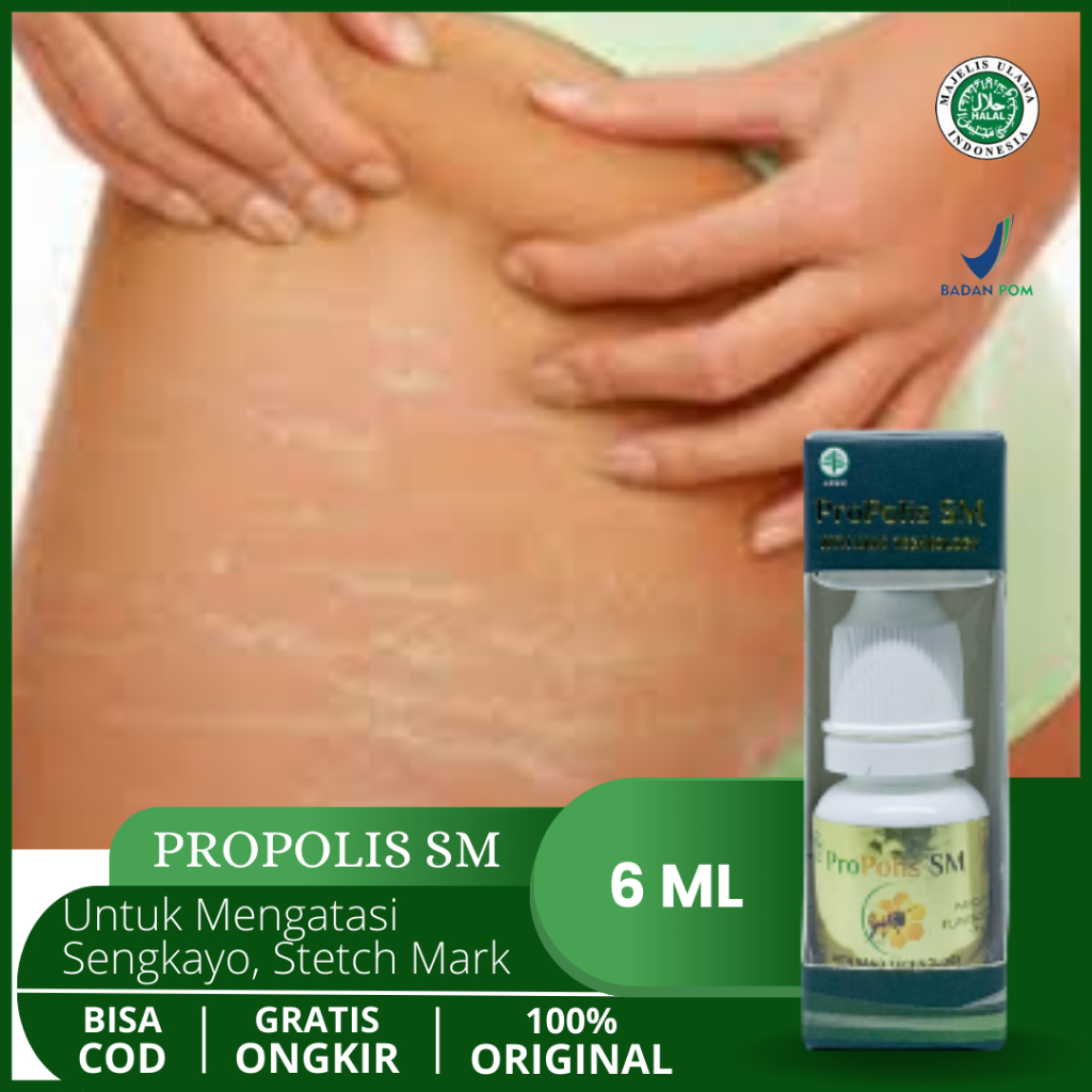 Obat Penghilang Singkayo, Selulit, Menghilangkan Stretch Mark Di Betis, Menghilangkan Stretch Mark I