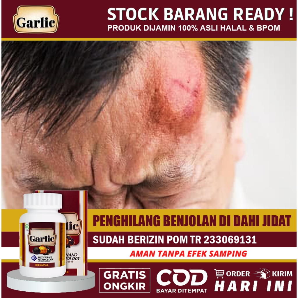 Obat Benjolan di Dahi, Obat Penghilang Benjolan di Jidat, Pengempis Benjolan di Kepala | Walatra Bla