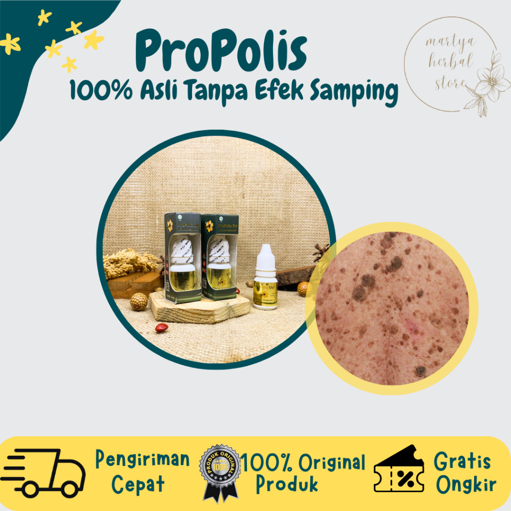 Obat Herbal Keratosis Seboroik Obat Kanker Kulit Melanoma Obat Keratosis Seboroik Di Wajah Obat Peng