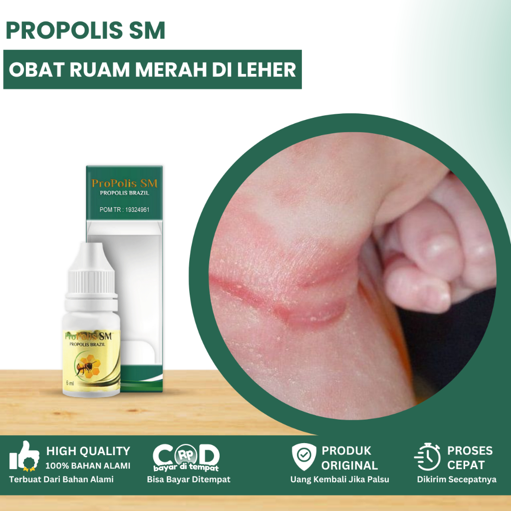 Obat Ruam Merah Di Lipatan Leher Bayi, Obat Ruam Merah Pada Bayi, Obat Luka Berair, Lecet Perih, Oba