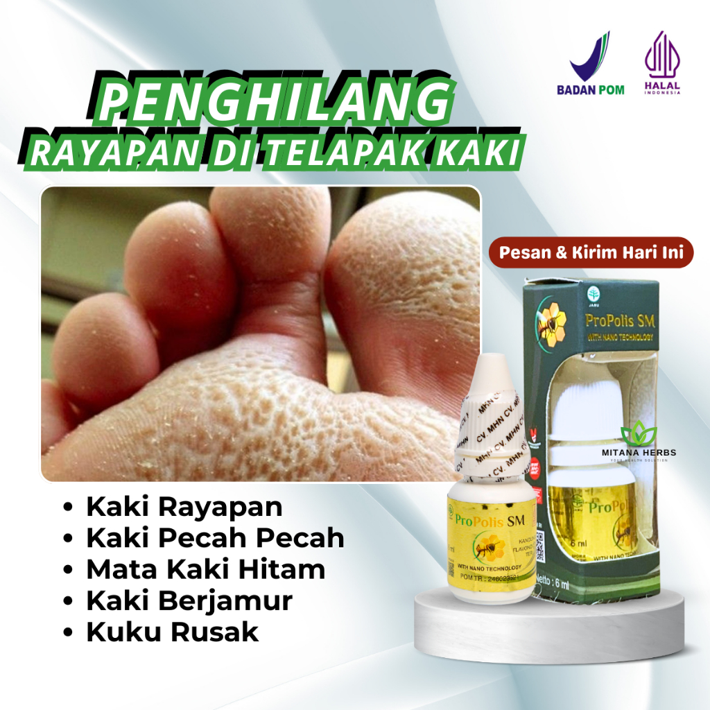 Obat Telapak Kaki Rayapan - Obat Kaki Rayapan Dan Bau - Obat Telapak Kaki Bolong - Obat Kaki Rayapan