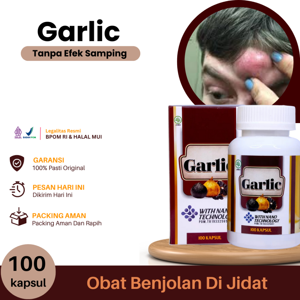 Obat Benjolan Di Jidat, Benjolan di Jidat Kiri Kanan, Benjolan Di Tengah Jidat, Hilangkan Benjolan U