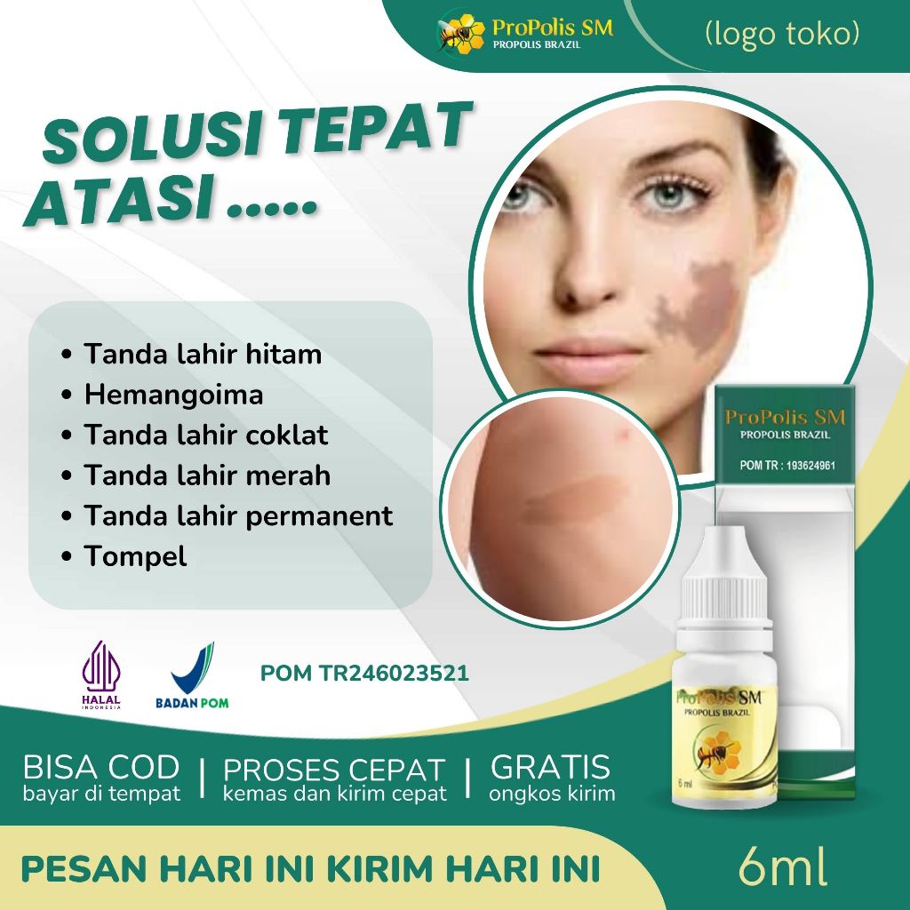 Penghilang Tanda Lahir, Oles Tanda Lahir, Hemangioma, Tanda Lahir, Tanda Lahir Coklat, Tanda Lahir H