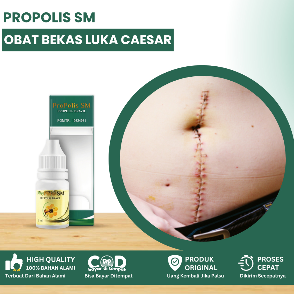 Obat Luka Caesar, Obat Pengering Luka Pasca Operasi, Obat Penghilang Bekas Luka Operasi Caesar, Obat