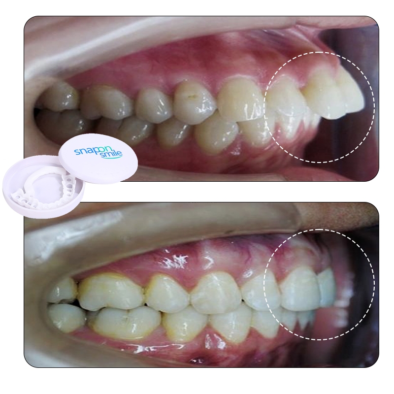 Perapih gigi Aligner gigi Behel gigi original asli dokter Perata gigi Perapih gigi tonggos original 