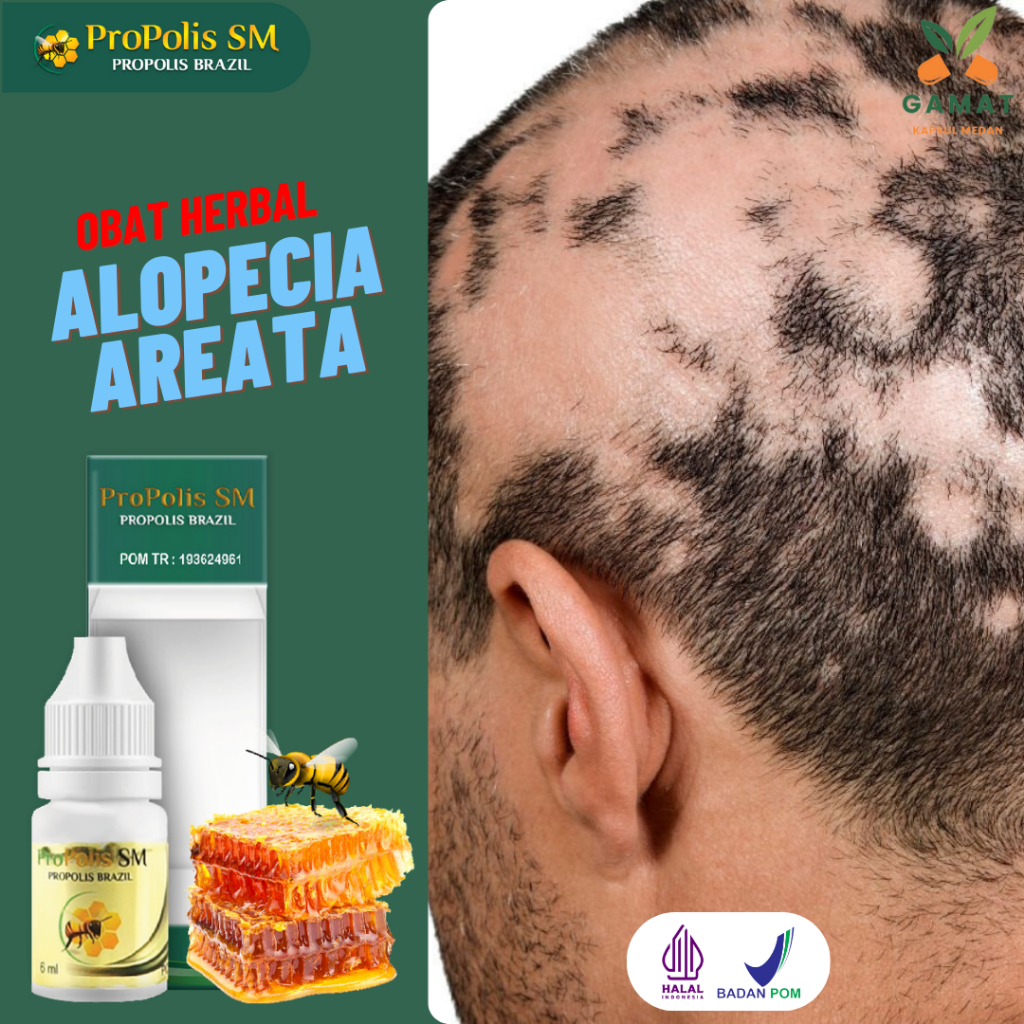 Obat Alopecia Areata Penumbuh Rambut Rontok Infeksi Jamur Kepala Kulit Kepala Gatal Borok