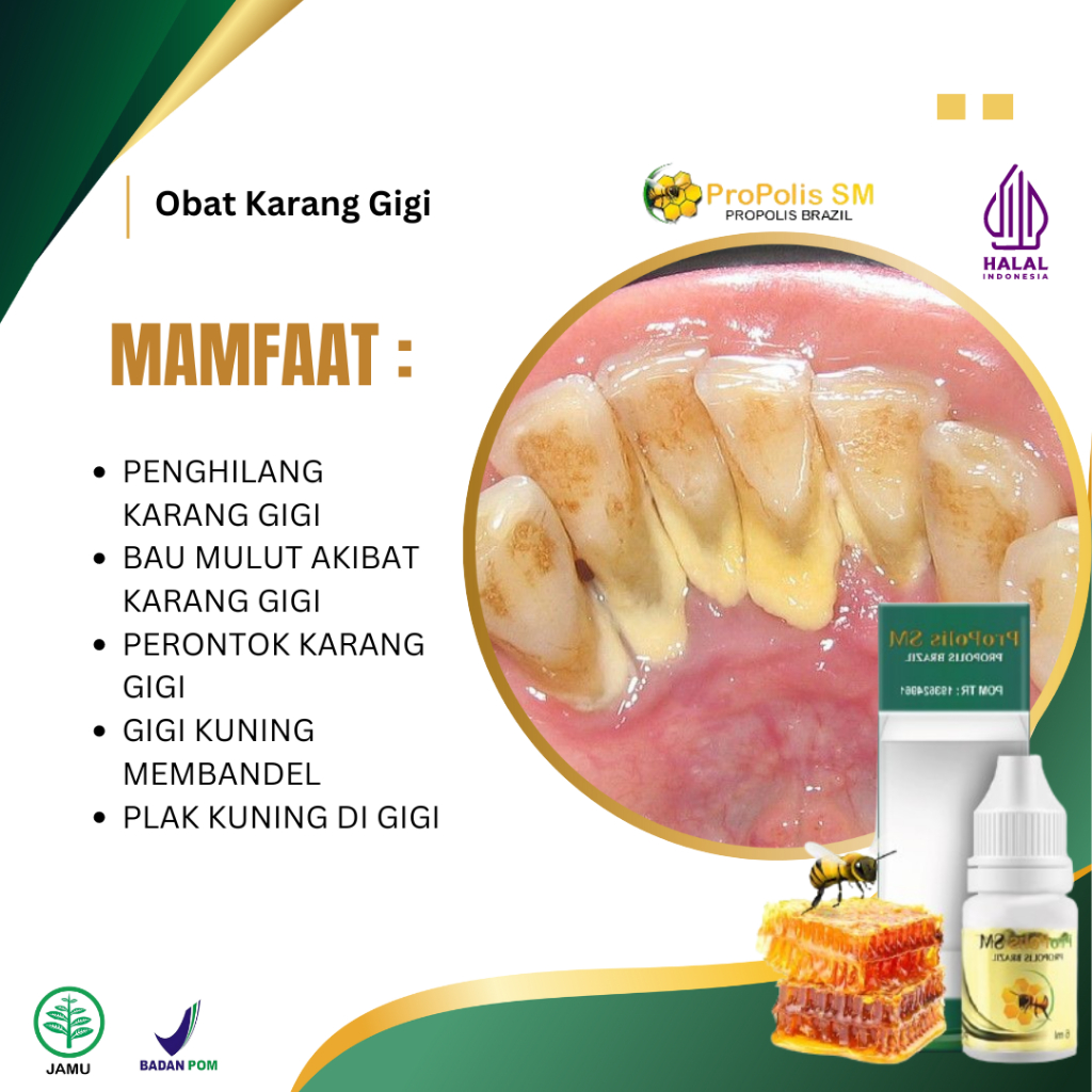 Obat Perontok Karang Gigi, Obat Herbal Karang Gigi, Obat Anti Karang Gigi Membandel, Obat Penghilang