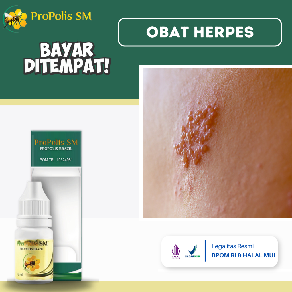 Obat Herpes, Obat Herpes Zoster, Obat Herpes Kulit, Obat Penyakit Herpes, Obat Herpes Genital, Obat 