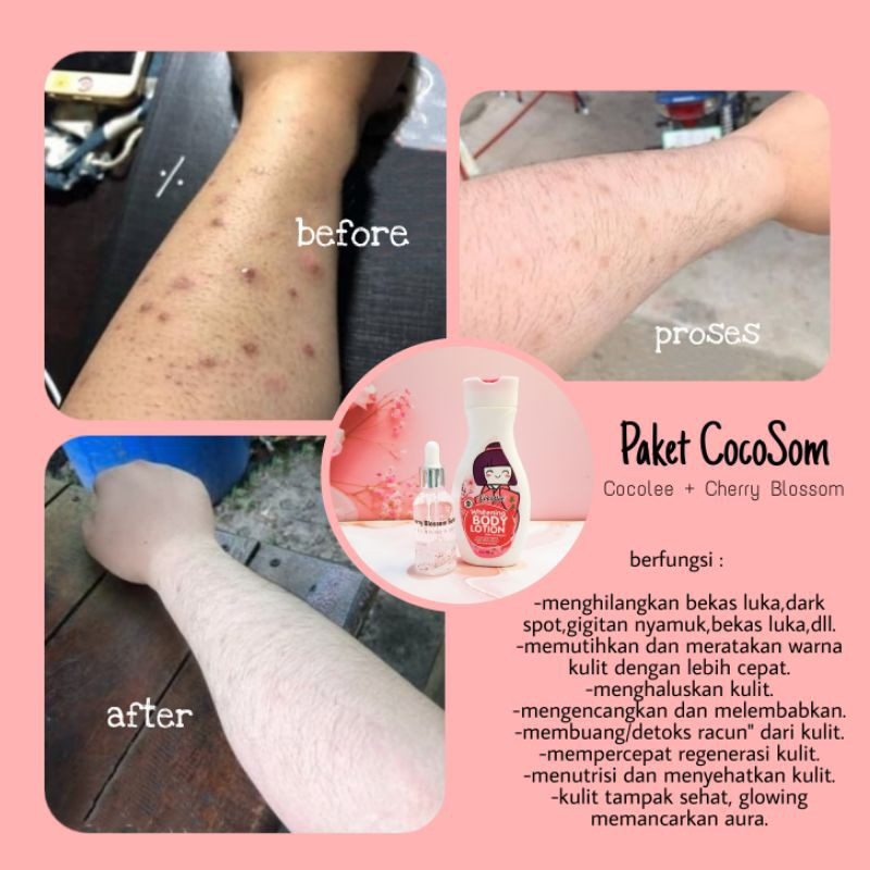 BEST SELLER!!! PENGHILANG BEKAS LUKA KORENG BUDUKAN + PEMUTIH KULIT PAKET COCOSOM SERUM + LOTION SKI