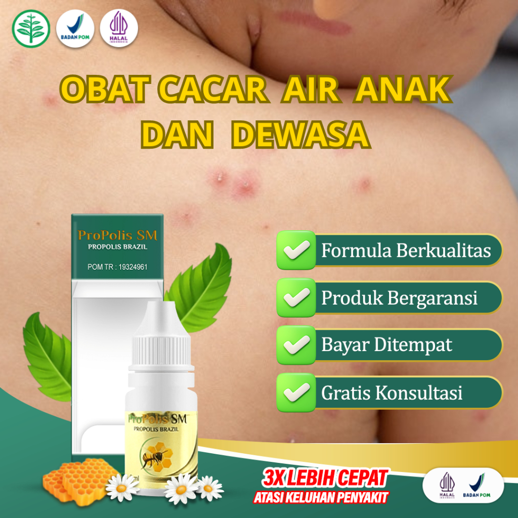 propolis sm obat cacar air ruam merah gatal gatal untuk anak dan dewasa propolis sm asli di solo