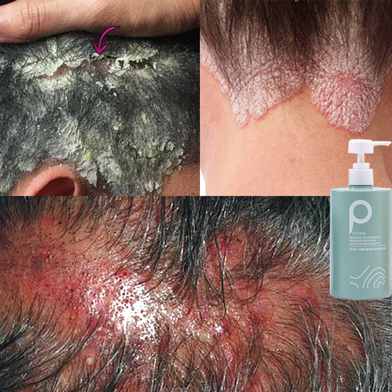 shampoo anti ketombe shampoo dermatitis seboroik shampoo psoriasis anti tungau shampoo rambut rontok