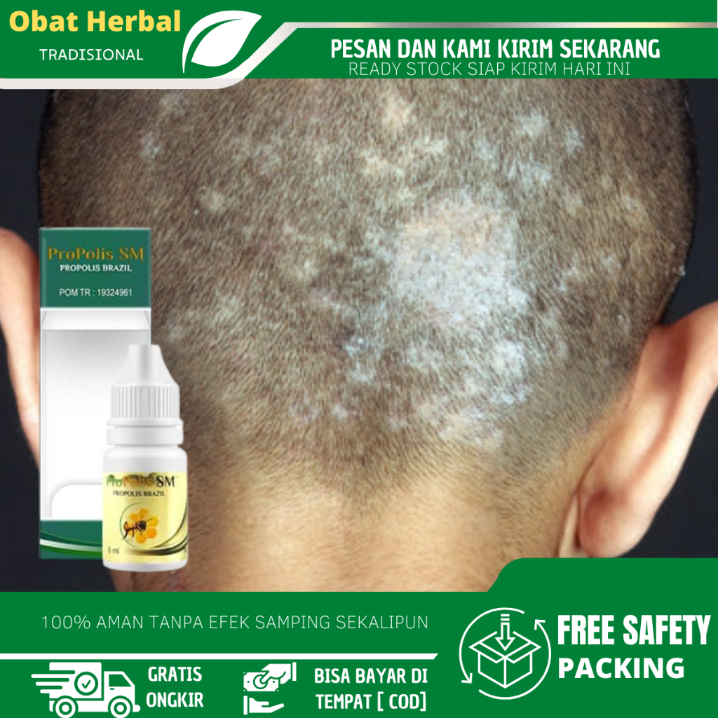 Obat Ketombe Berkerak Parah, Obat Jamur Kulit Kepala, Obat Tinea Capitis, Salep Borok Kulit Kepala, 