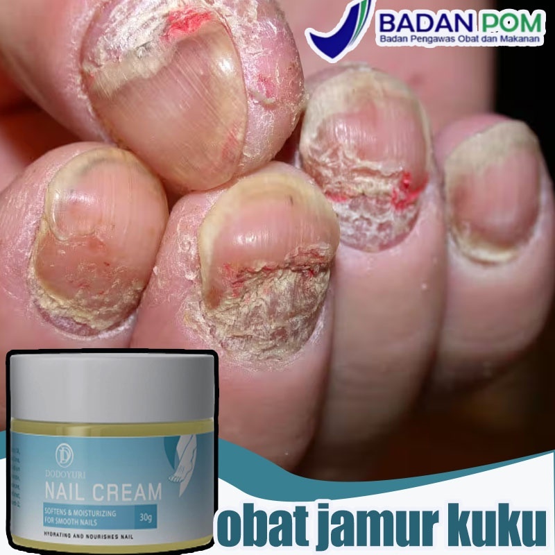 Obat jamur kuku Obat kuku Obat cantengan Serum kuku jamur dan rusak 30g Obat kuku jamur dan rusak ob