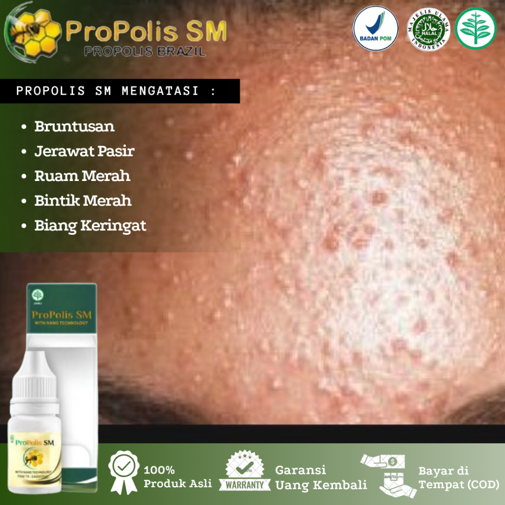 Propolis SM Salep Oles Bruntusan, Bruntusan di Jidat, Bruntusan di Wajah, Biang Keringat, Gatal Brun