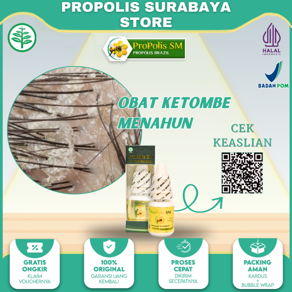 Obat Ketombe Berkerak, Ketombe Menahun, Ketombe Basah, Ketombe Kering - Propolis Sm di Surabaya