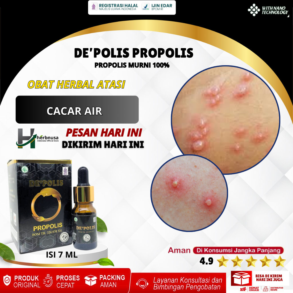 Obat Cacar Air, Obat Cacar Monyet Monkeypox, Obat Gatal Alergi Berair / Bernanah / Bentol / Bintil P