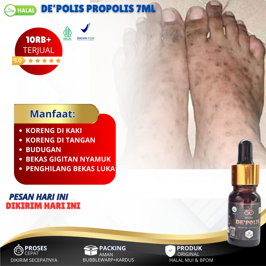 Obat Koreng Bernanah, Gatal Koreng Bernanah, Koreng Di Kaki, Koreng Di Kepala, Bekas Koreng Hitam, O