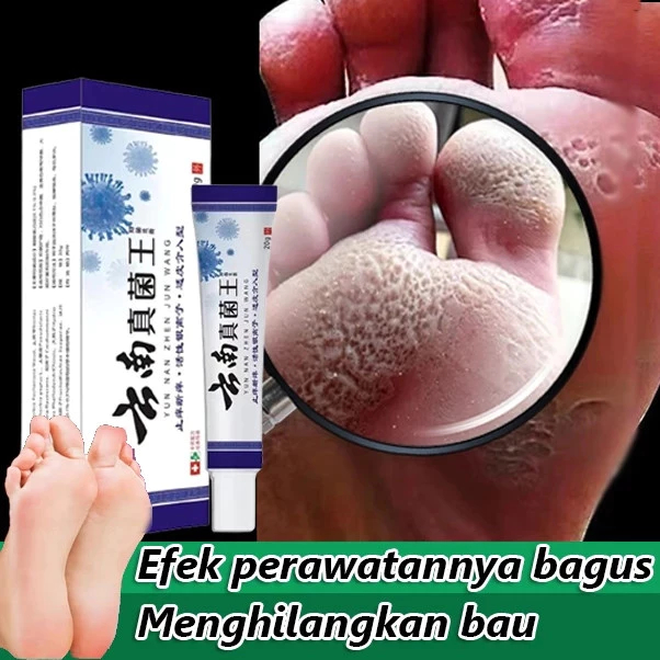Salep Gatal di Sela Jari Kaki dan Tangan Obat Kutu Air Kurap Kudis Infeksi Jamur Obat Gatal Berair d