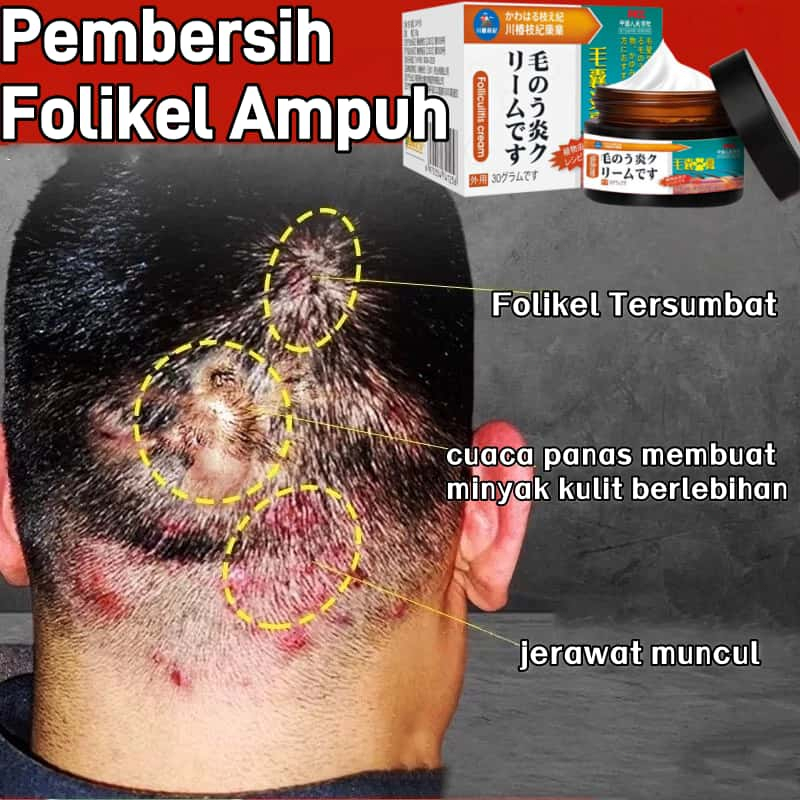 obat krim Borok di Kepala krim Kepala Gatal, Tinea Kapitis,krim Jamur Kulit Kepala krim Dermatitis S