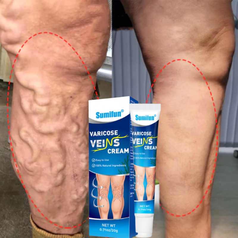 Obat varises Salep varises paling ampuh Varicose veins cream Krim Varises Di Kaki Dan Betis Menghila