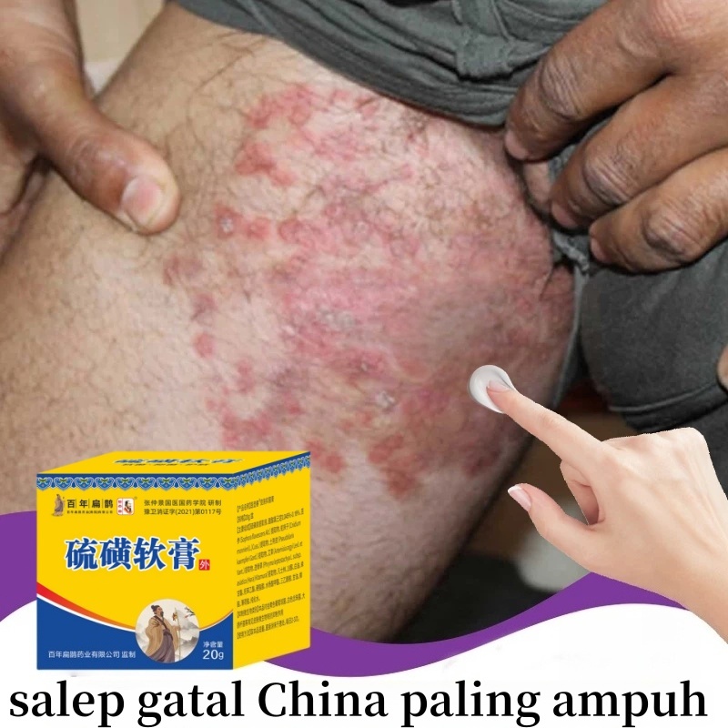 salep eksim，salep gatal，salap gatal kulit yang ampuh，saleb gatal paling ampuh Menghambat Dermatitis 