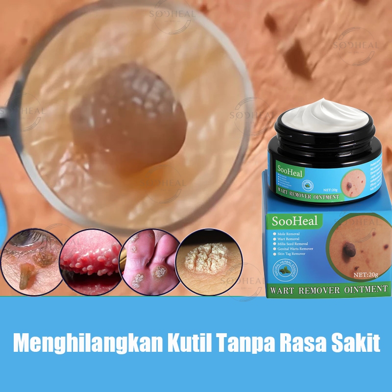 Penghilang kutil Salep kutil paling ampuh Salep kutil Obat penghilang kutil Salep kutil kelamin laki