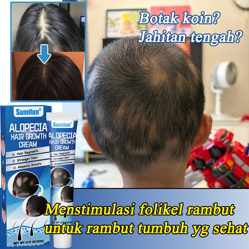 Obat penumbuh rambut Obat Alopecia Areata Rambut Pitak 20g penumbuh rambut serum penumbuh rambut bot