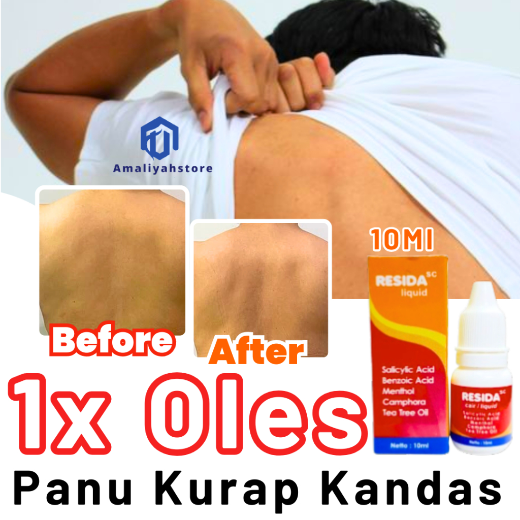 Obat Panu Obat Gatal Selangkangan Hitam Kadas Hapur Kulit Seluruh Badan Resida Cair Original Ampuh