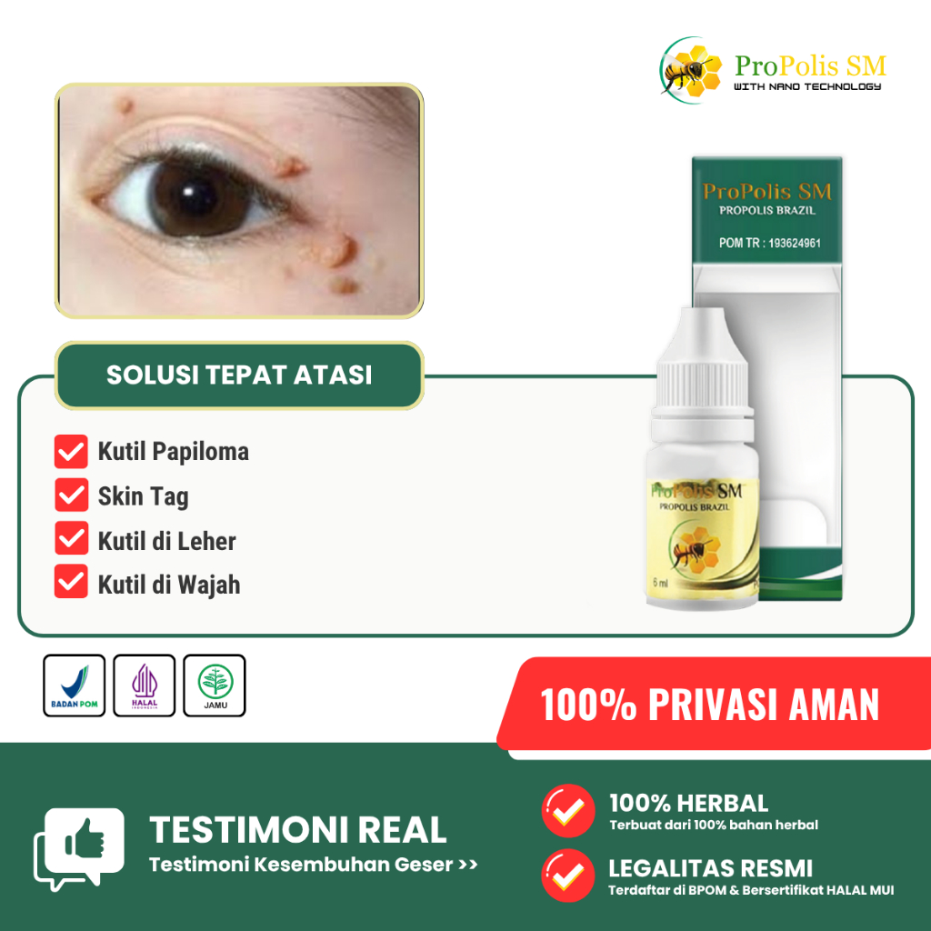 Obat Kutil Papiloma, Kutil di Leher, Kutil di Wajah, Perontok Kutil, Penghilang Kutil, Propolis SM