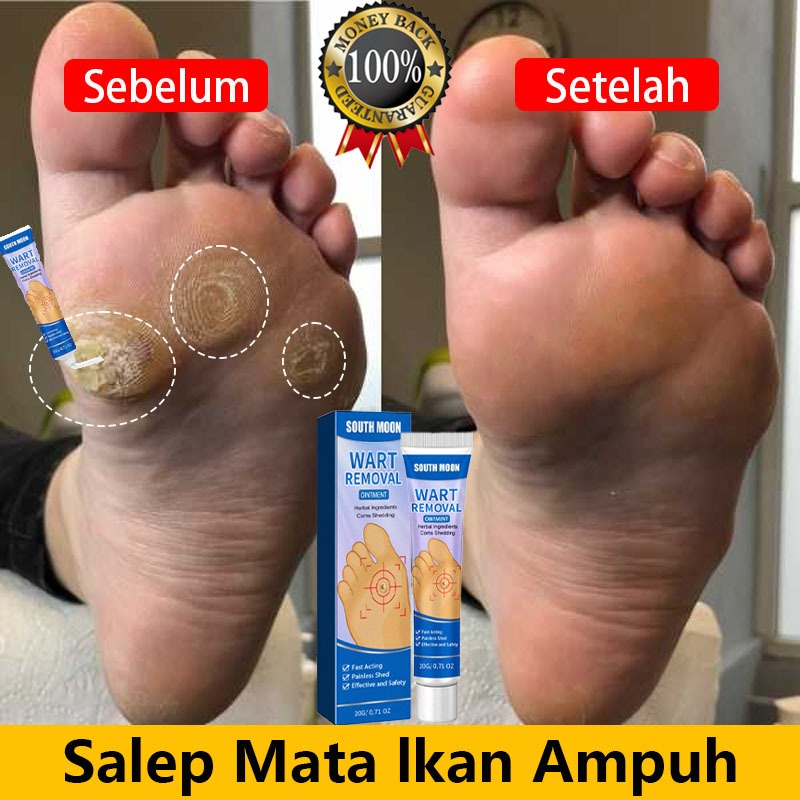 Salep Mata Ikan Mata Ikan Paling Ampuh Telapak Kaki Obat Mata Ikan Kaki Penghilang Mata Ikan Di