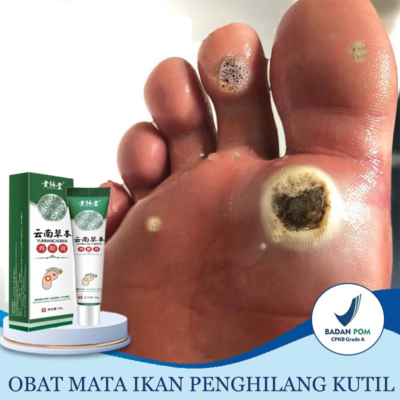 Salep mata ikan telapak kaki /Obat penyakit mata ikan / Obat Mata Ikan Pada Telapak Kaki / Kapalan /