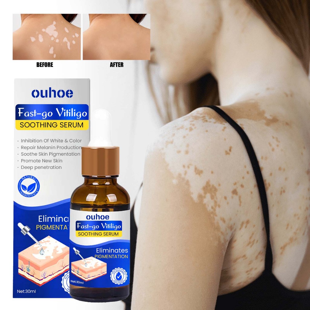 OUHOE Vitiligo Repair Serum 30ml Obat Vitiligo Salep Vitiligo  Salep Salep Vitiligo Ori 100% Vitilig