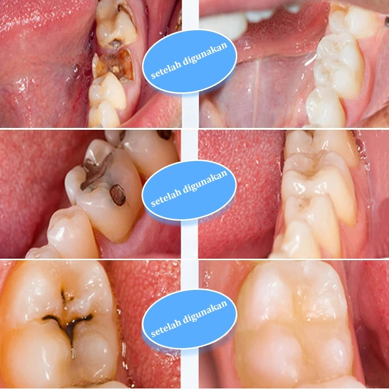 Obat sakit gigi berlubang ampuh Obat sakit gigi paling ampuh obat sakit gigi ampuh Obat gigi