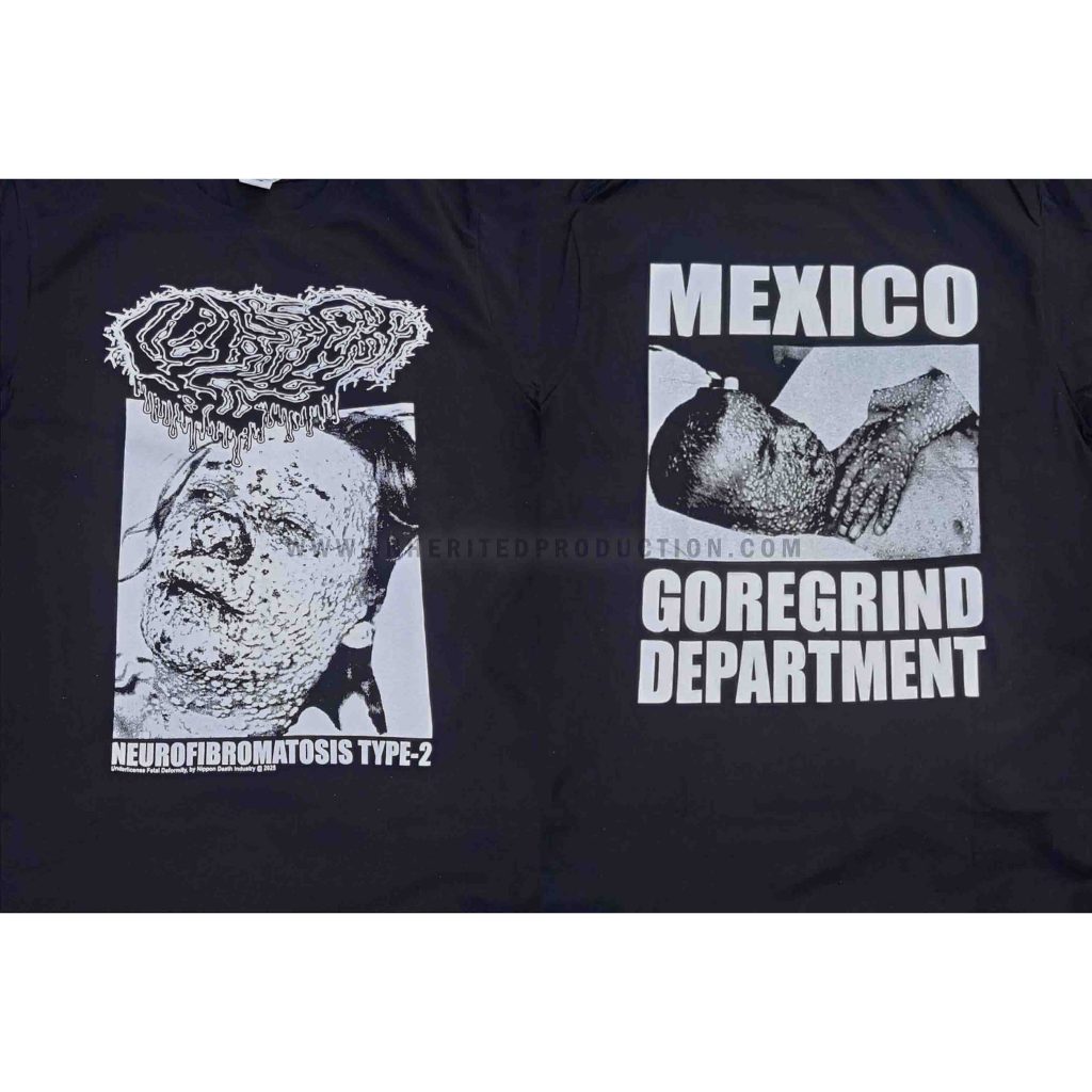 TS – FETAL DEFORMITY – NEUROFIBROMATOSIS TYPE-2