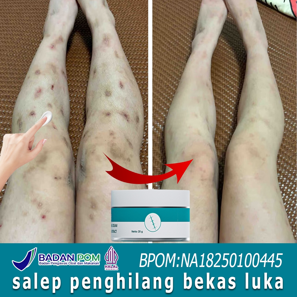 Salep luka bakar salep penghilang bekas luka penghilang bekas luka hitam koreng salep bekas luka 20g