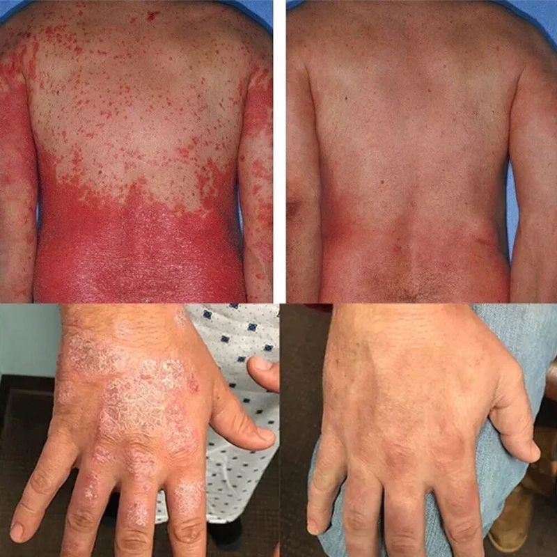 Salep Eksim Kering Dan Gatal Salep Gatal China Paling Ampuh Obat Gatal Selangkangan Salep Bayi Untuk