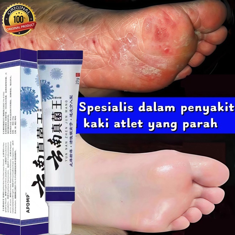 Obat gatel Obat gatal gatal kulit Obat gatal gatal di kemaluan jamur Obat gatal gatal kulit china sa