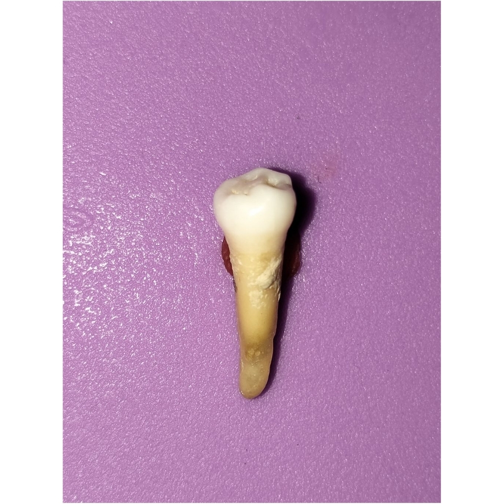 Gigi asli premolar 35