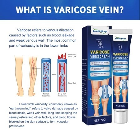 South Moon Varicose Veins Cream 20gr Obat Varises Salep Obat Varises Kaki Menghilangkan Varises Di K